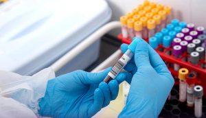 معرفی آزمایشات لازم قبل از کاشت مو