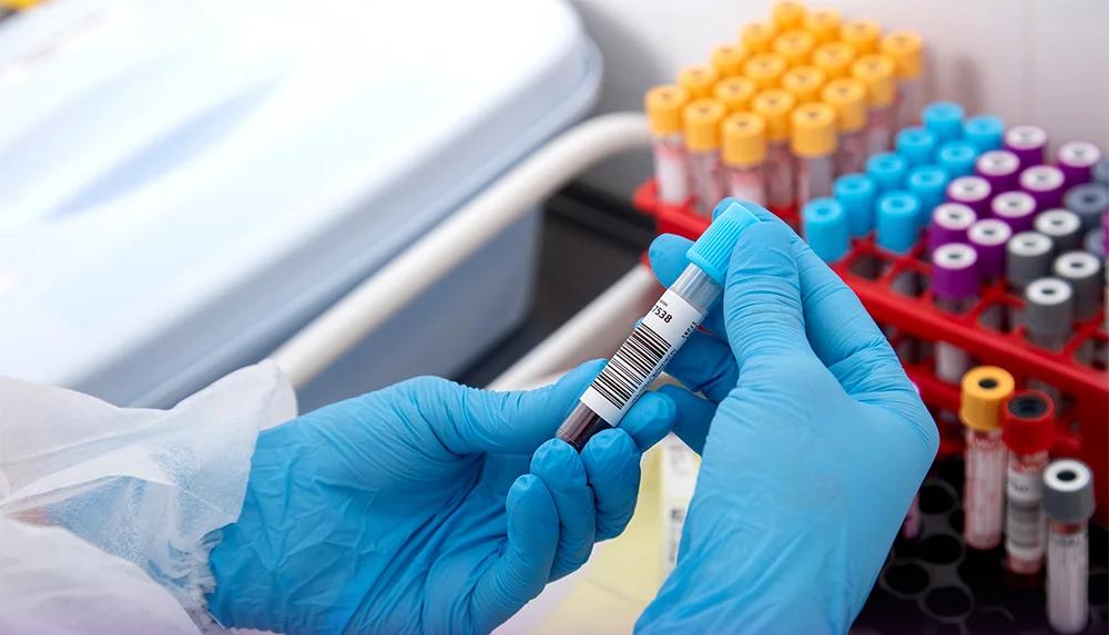 معرفی آزمایشات لازم قبل از کاشت مو