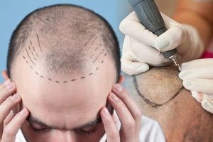 جدیدترین روش کاشت مو ۲۰۲۴