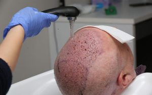 مراقبت های بعد از کاشت مو