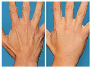 جوانسازی و رفع چروکهای پوست دست با تزریق چربی