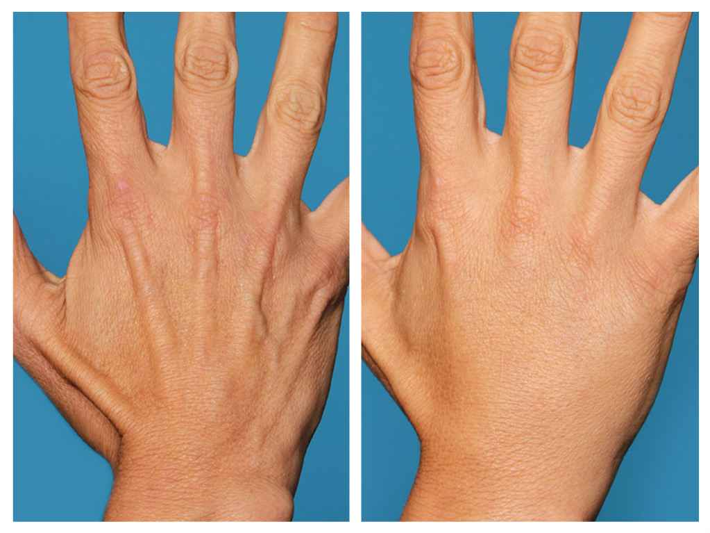 جوانسازی و رفع چروکهای پوست دست با تزریق چربی