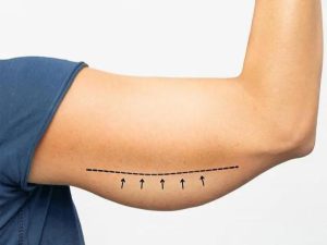 درمان افتادگی بدن با اندولیفت