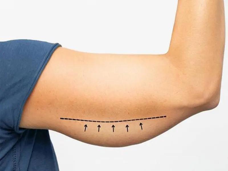 درمان افتادگی بدن با اندولیفت