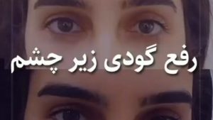 درمان گودی زیر چشم