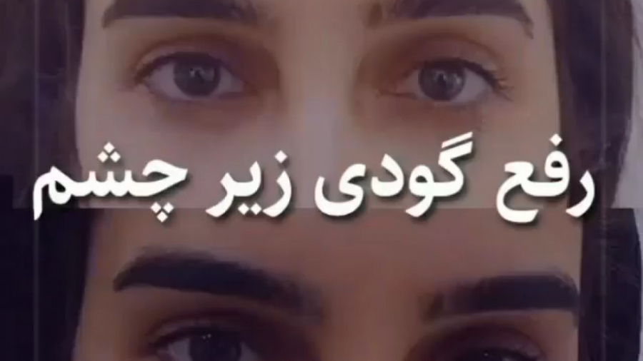 درمان گودی زیر چشم