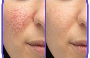 لیزر فرکشنال CO2