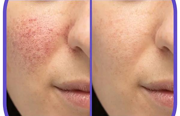 لیزر فرکشنال CO2