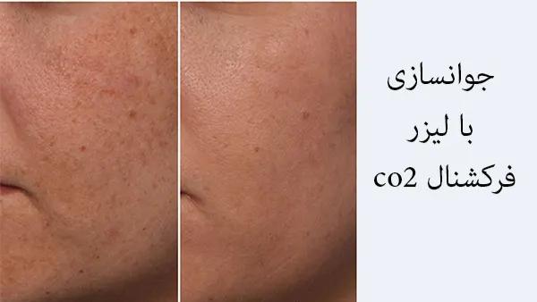 نکات مهم جهت استفاده از لیزر فرکشنال CO2