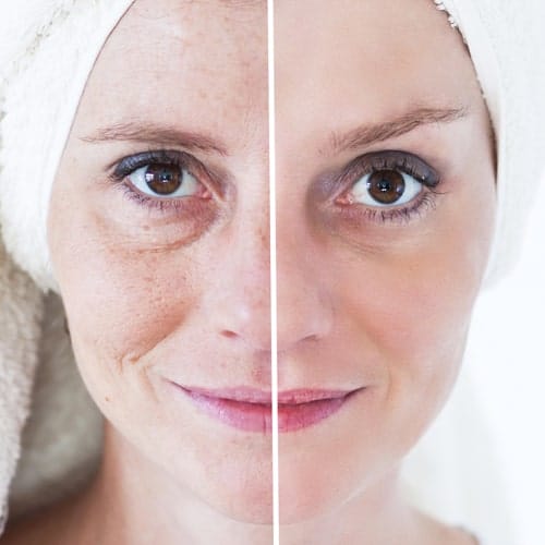 در بین روش های لیزر برای جوانسازی پوست کدام یک بهتر است؟