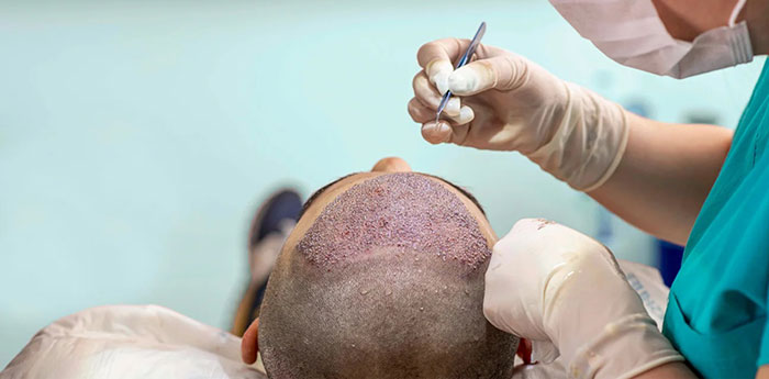 به دستورات پزشک در مورد مراقبت های بعد از کاشت مو پایبند باشید