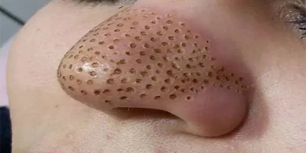 عوارض پلاسما جت بینی