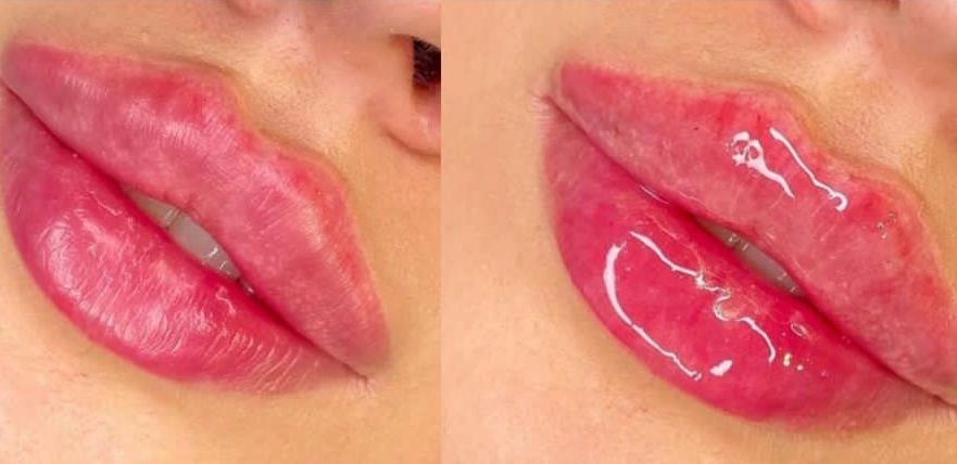 فیلر لب چقدر ماندگاری دارد؟
