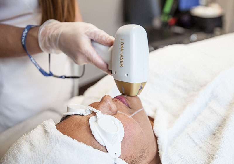 لیزر موهای زائد