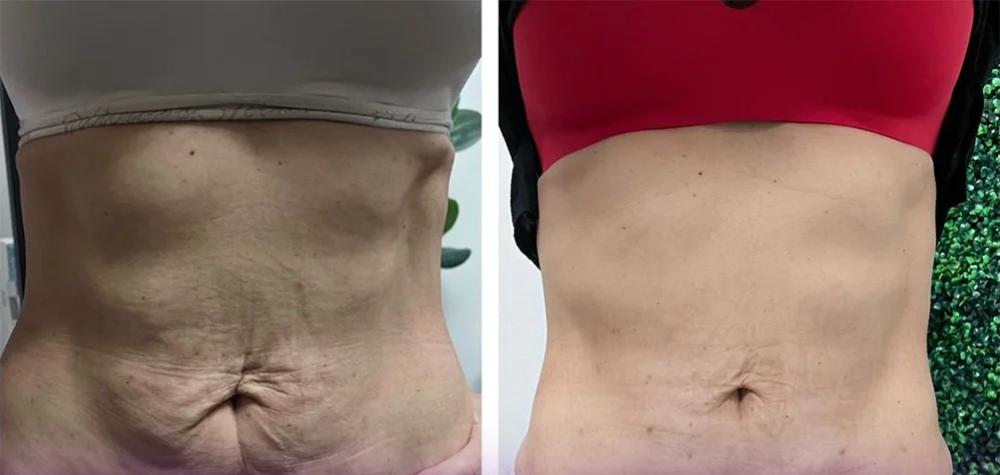 معایب درمان افتادگی بدن با اندولیفت