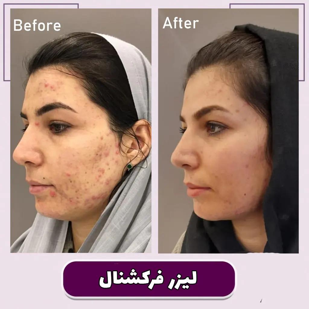 قابلیت های لیزر فرکشنال CO2