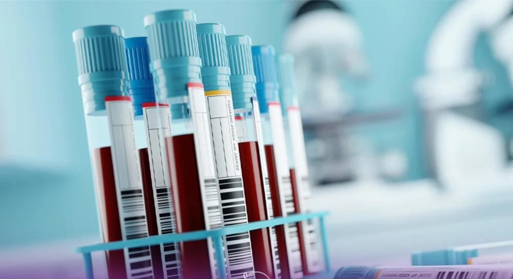 لزوم انجام آزمایش قبل از کاشت مو