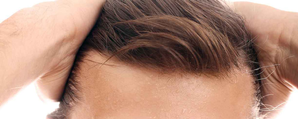 جدیدترین روش‌های کاشت مو در ایران با تراکم بالا