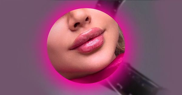 مراقبت‌‌های مور نیاز بعد از انجام فیلر لب