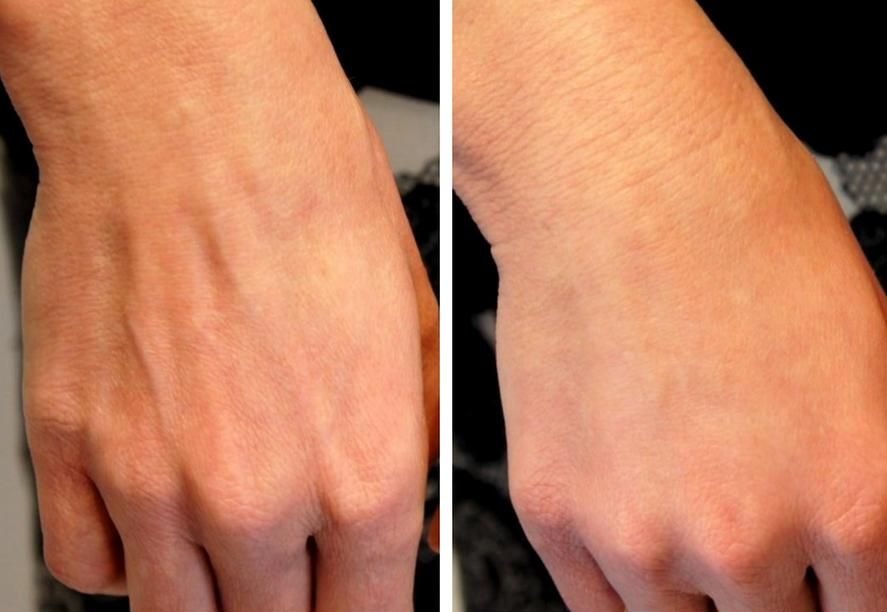 جوانسازی و رفع چروکهای پوست دست با تزریق چربی