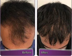 جدیدترین روش مزوتراپی مو