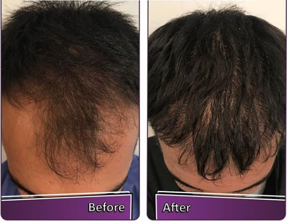 جدیدترین روش مزوتراپی مو