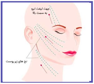 لیفت نخ ابرو چیست؟