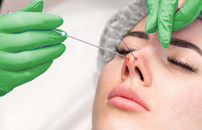 تفاوت های لیفت نخ با جراحی های پلاستیک