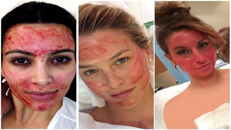 اقدامات احتیاطی قبل از میکرونیدلینگ جهت کاهش عوارض