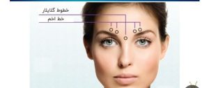 نقاط تزریق بوتاکس برای بالا بردن ابرو