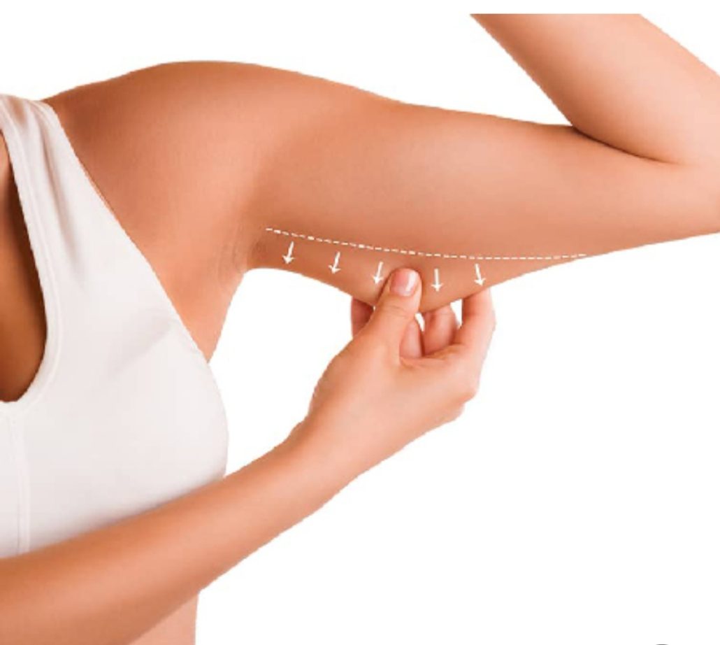 لیفت بازو با نخ