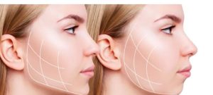 زاویهسازی فک با نخ