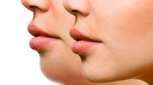 سریعترین راه رفع غبغب