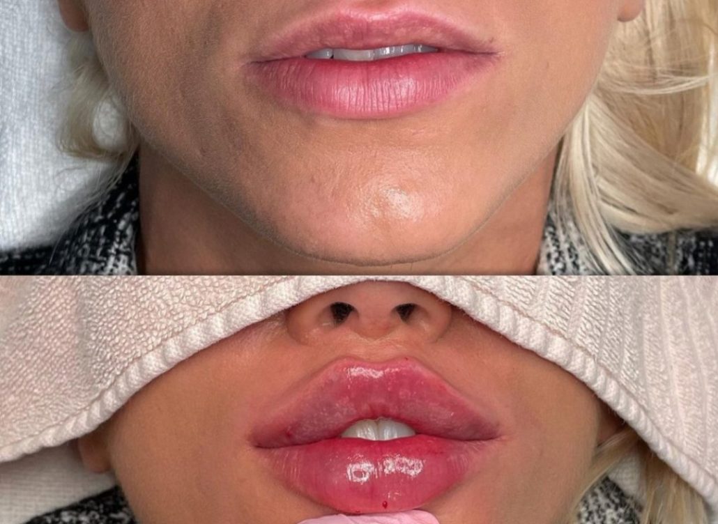 فیلر لب پروانه‌ای