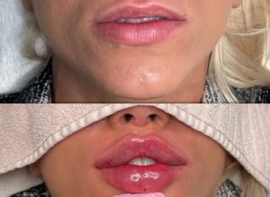 فیلر لب پروانهای