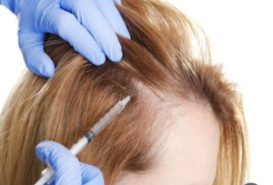 مزایای مزوتراپی مو