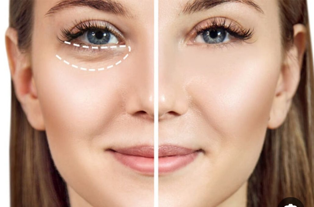 مزوتراپی زیر چشم