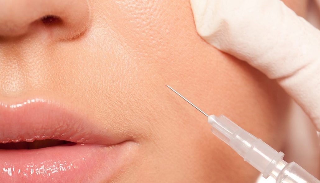 تزریق خط خنده چیست؟