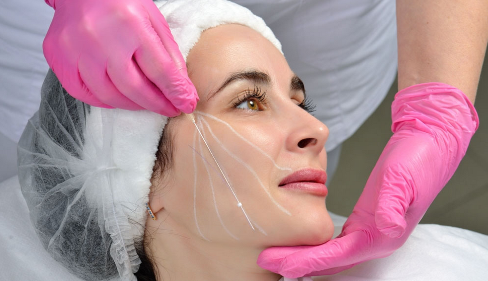 مراحل انجام لیفت توسط نخ آپتوس