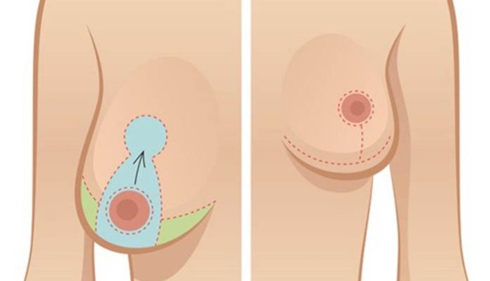 مزایا و معایب لیفت سینه