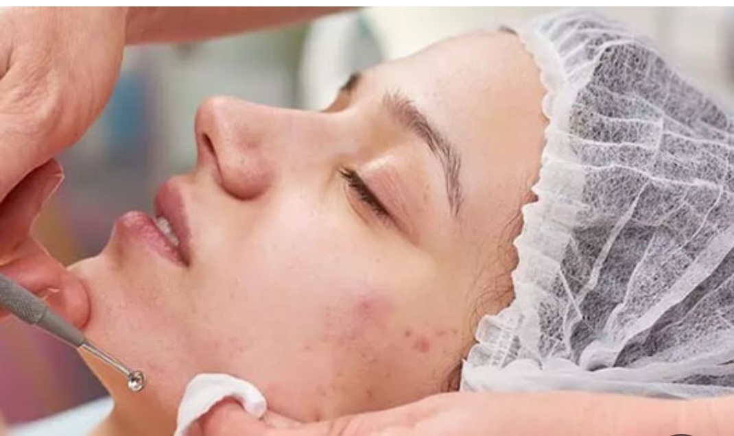 مراقبت‌های بعد از فیشیال