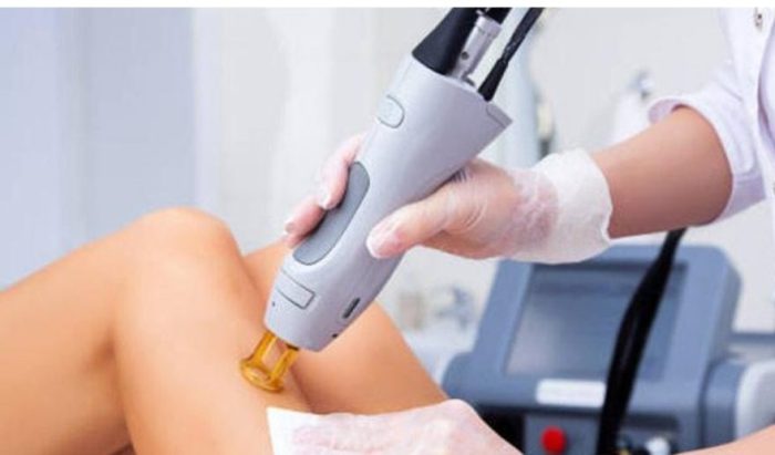 مراقبت‌های بعد از لیزر موهای زائد