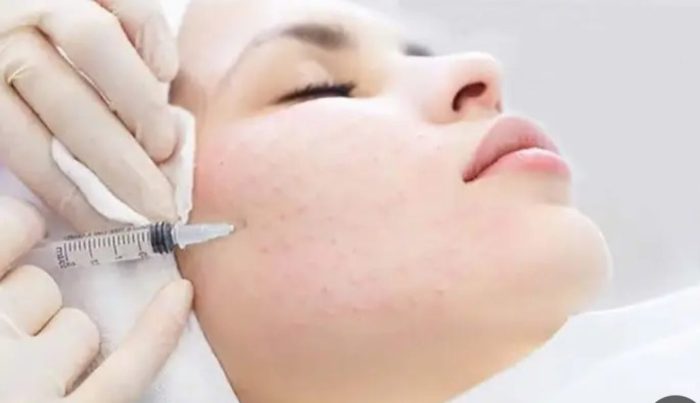 مزایای مزوتراپی پوست