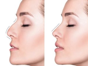 لیفت بینی با نخ بدون جراحی