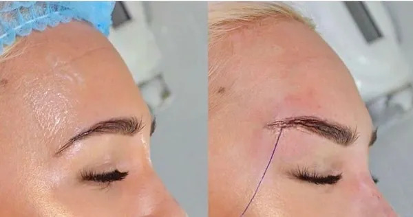 لیفت چشم با نخ