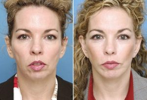 انواع تزریق چربی به گونه ها