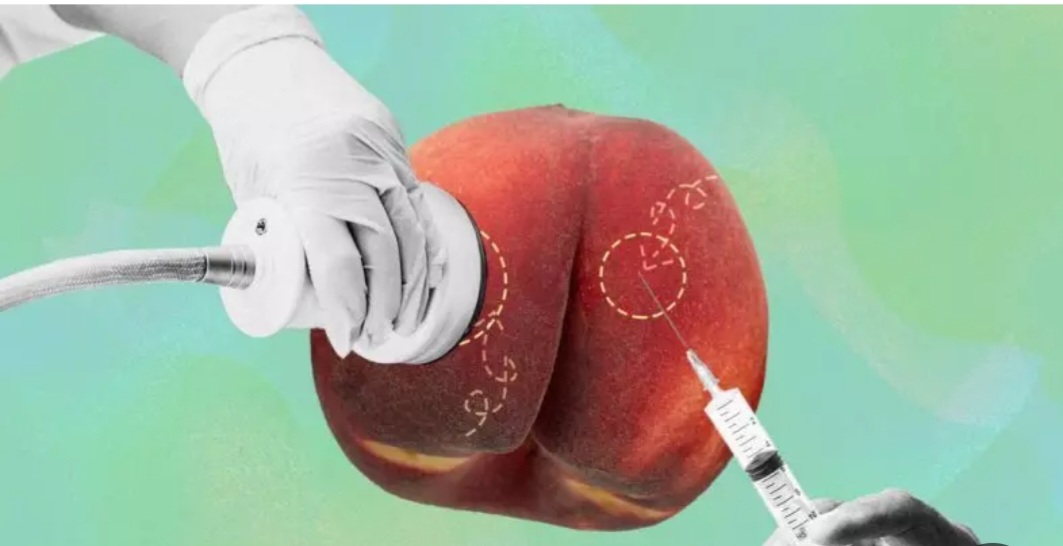 مزایای تزریق ژل به باسن چیست؟