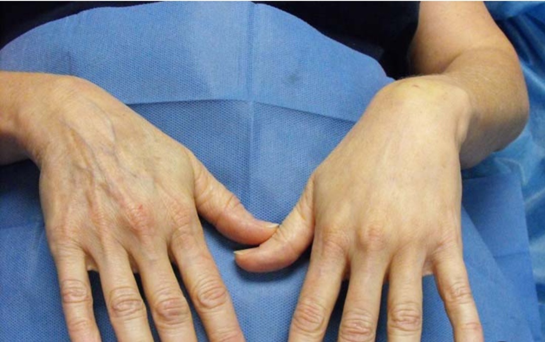 آیا تزریق فیلر در پشت دستها دردناک است؟