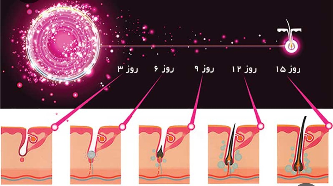 مزایای هیرفیلر چیست؟