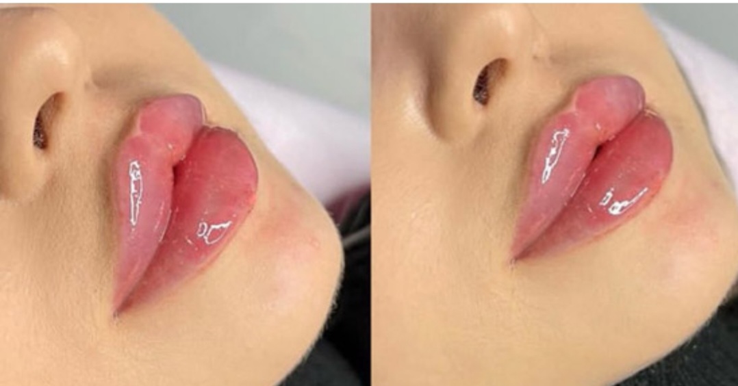 مراحل تزریق ژل لب مدل نچرال